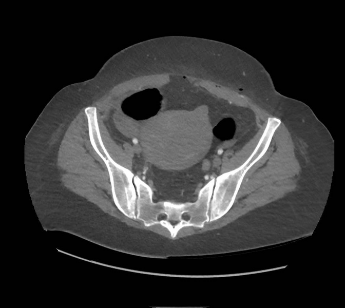File:Colonic pseudo-obstruction (Radiopaedia 79752-92980 A 151).png