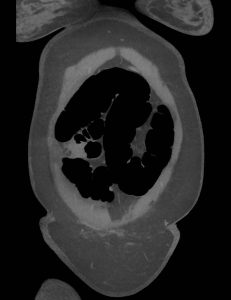 File:Colonic pseudo-obstruction (Radiopaedia 79752-92980 B 15).png