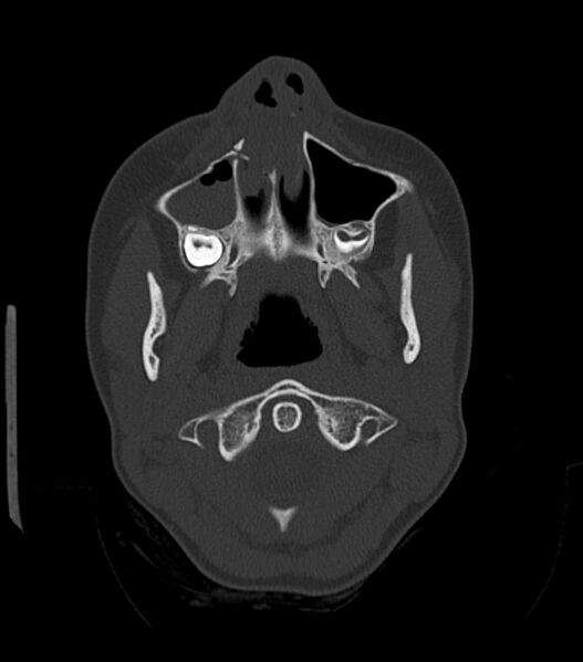 File:Nasoorbitoethmoid fracture (Radiopaedia 90044-107205 Axial bone window 55).jpg