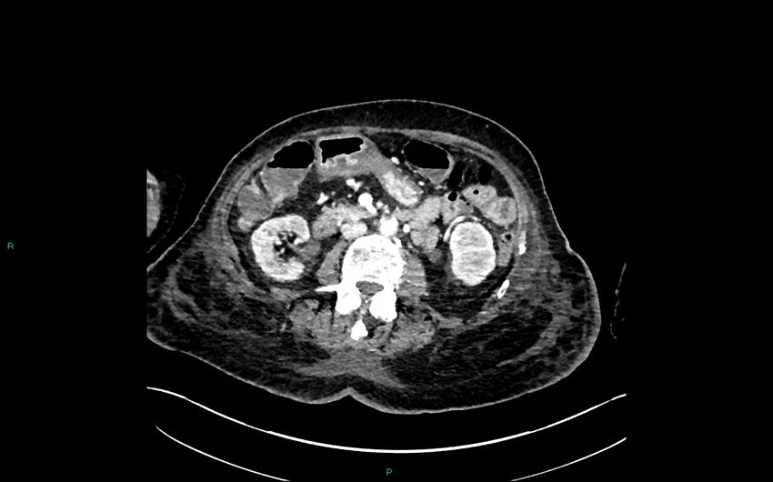 Neo-terminal ileal stricture (Crohn disease) (Radiopaedia 33790-34948 A 198).jpg
