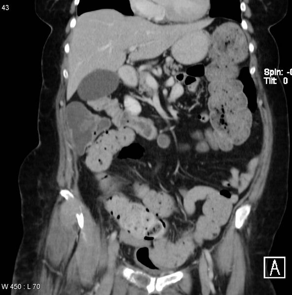 File:Nerve sheath tumor - malignant - sacrum (Radiopaedia 5219-6987 B 1).jpg
