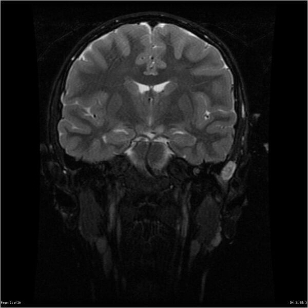 File:Neurofibromatosis type 1 (Radiopaedia 22541-22564 C 21).jpg