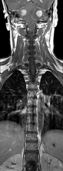 File:Neurofibromatosis type 2 (Radiopaedia 66211-75403 Coronal T1 C+ 5).jpg