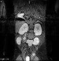 Neurofibromatosis type 2 - cranial and spinal involvement (Radiopaedia 5351-7112 D 6).jpg