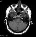 Neurosarcoidosis (Radiopaedia 10930-17204 Axial T1 4).jpg