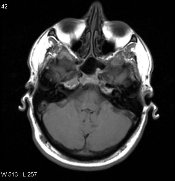 File:Neurosarcoidosis (Radiopaedia 10930-17204 Axial T1 4).jpg