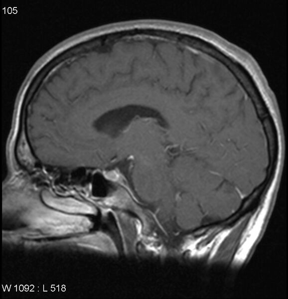 File:Neurosarcoidosis (Radiopaedia 10930-17204 Sagittal T1 C+ 10).jpg