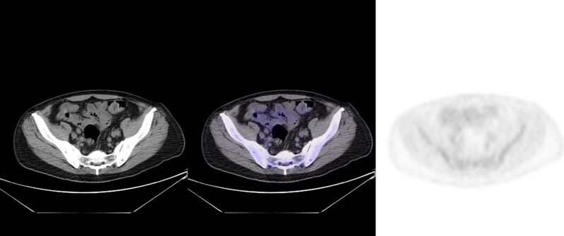 File:Non-Hodgkin lymphoma involving seminal vesicles with development of interstitial pneumonitis during Rituximab therapy (Radiopaedia 32703-33752 ax CT Fus PET 54).jpg