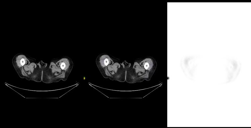File:Non-Hodgkin lymphoma involving seminal vesicles with development of interstitial pneumonitis during Rituximab therapy (Radiopaedia 32703-33761 ax CT Fus PET 65).jpg