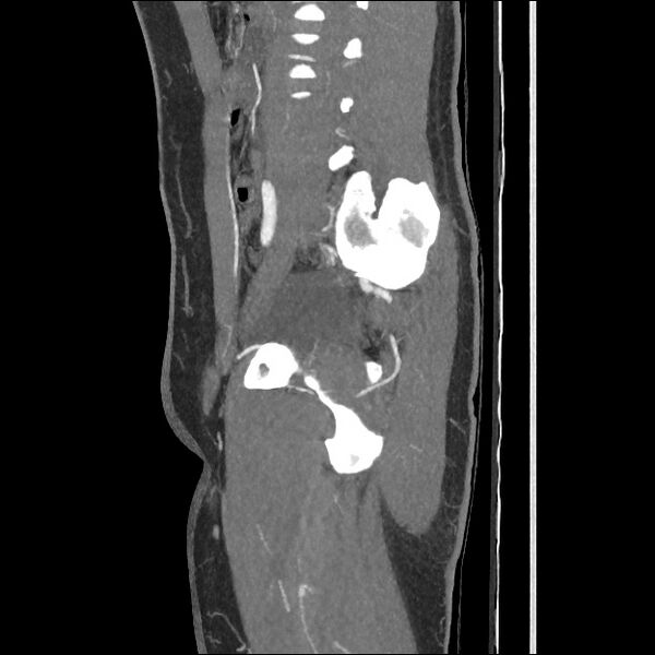 File:Normal CT angiogram of pelvis (Radiopaedia 45390-49430 C 27).jpg