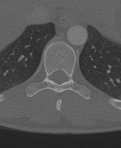 File:Normal CT thoracic spine (Radiopaedia 40181-42688 Axial bone window 72).png