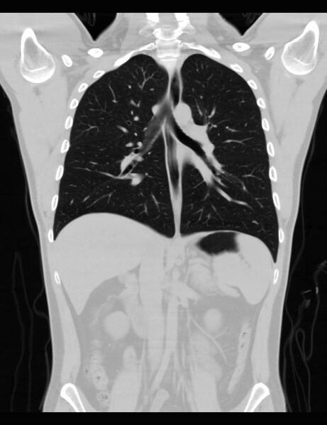 File:Normal CT virtual gastroscopy (Radiopaedia 29960-30501 F 3).jpg