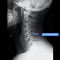Normal cervical spine radiographs (Radiopaedia 32505-96697 A 11).jpeg