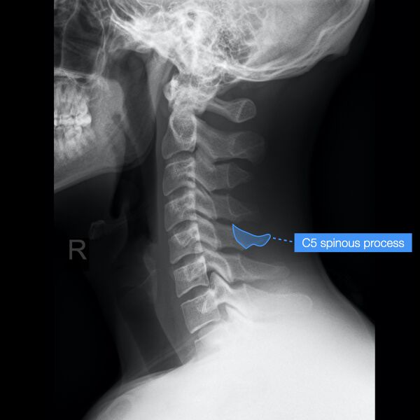 File:Normal cervical spine radiographs (Radiopaedia 32505-96697 A 11).jpeg