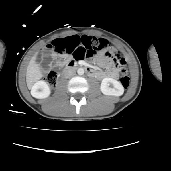 File:Normal dual-phase trauma CT chest,abdomen and pelvis (Radiopaedia 48092-52899 A 70).jpg