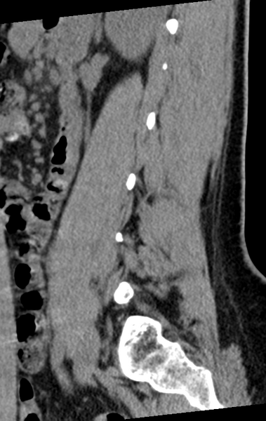 File:Normal lumbar spine CT (Radiopaedia 46533-50986 C 28).png