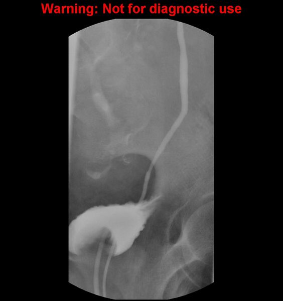 File:Normal retrograde pyelography of a native and transplant kidney (Radiopaedia 40480-43054 Native kidney 21).jpg