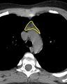 Normal thymus (Radiopaedia 39553-41860 Axial non-contrast 1).jpg