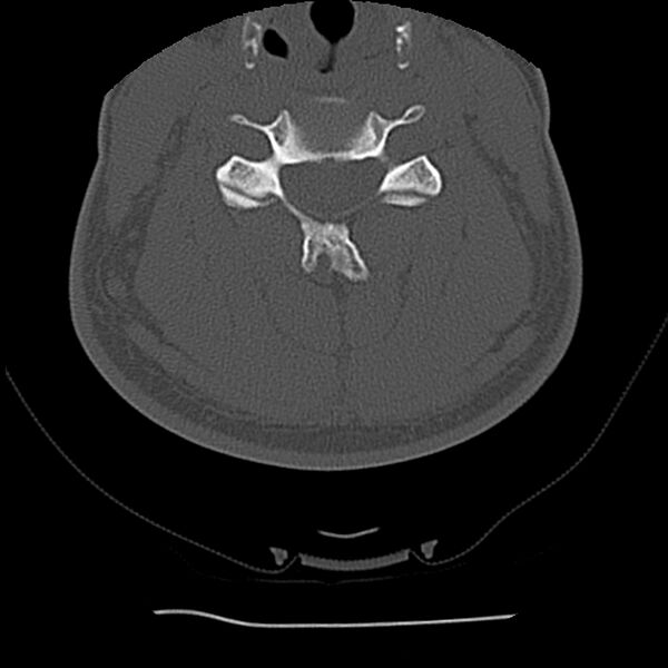 File:Normal trauma spine imaging (Radiopaedia 31753-32686 Axial bone window 44).jpg