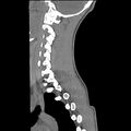 Normal trauma spine imaging (age 16) (Radiopaedia 45335-49358 C 29).jpg