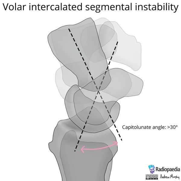 File:Normal wrist alignment, dorsal and volar intercalated segmental instability (illustration) (Radiopaedia 80949-94490 A 4).png