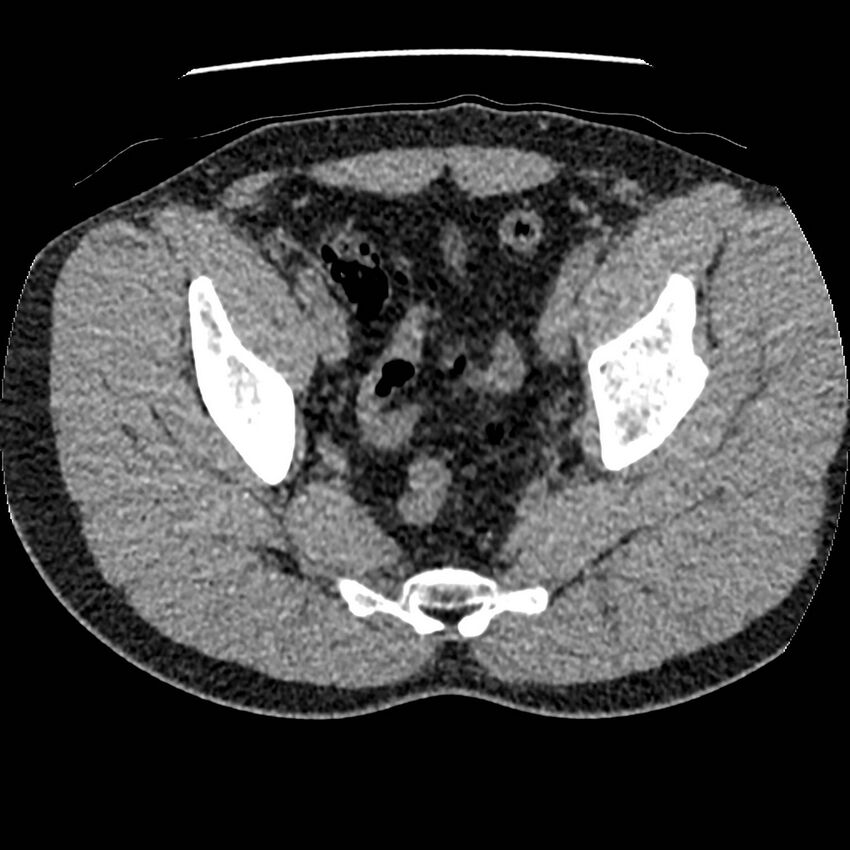 Obstructing ureteric calculus and ureteric anatomy (Radiopaedia 62730-71042 Axial non-contrast 143).jpg