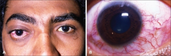 This 25-year-old man presented with chief complaints of right eye proptosis, decreased vision and elevated intraocular pressure a). Closer examination revealed dilated episcleral vessels. Based on history and imaging studies, diagnosis of CCF was made b)