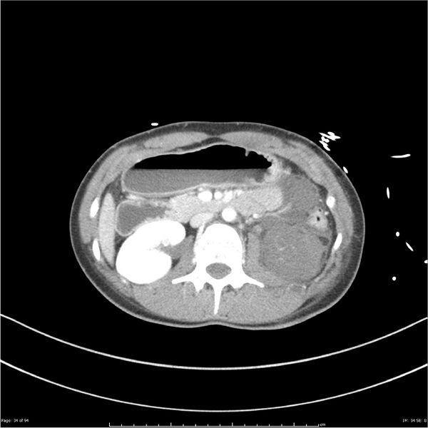 File:Traumatic renal artery dissection and pancreatic transection (Radiopaedia 37061-38739 Axial 235).jpg