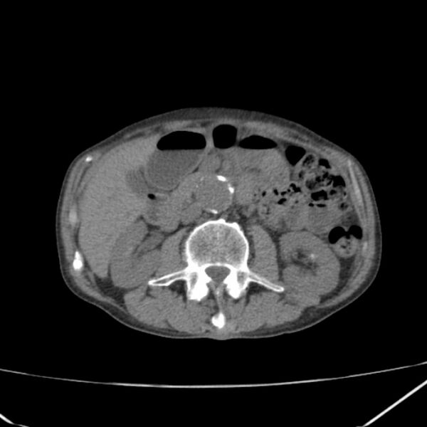 File:Abdominal aortic aneurysm (Radiopaedia 23703-23856 Axial non-contrast 23).jpg