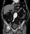 Abdominal aortic aneurysm (Radiopaedia 25855-26001 Coronal C+ arterial phase 25).jpg