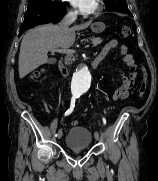 File:Abdominal aortic aneurysm (Radiopaedia 25855-26001 Coronal C+ arterial phase 25).jpg