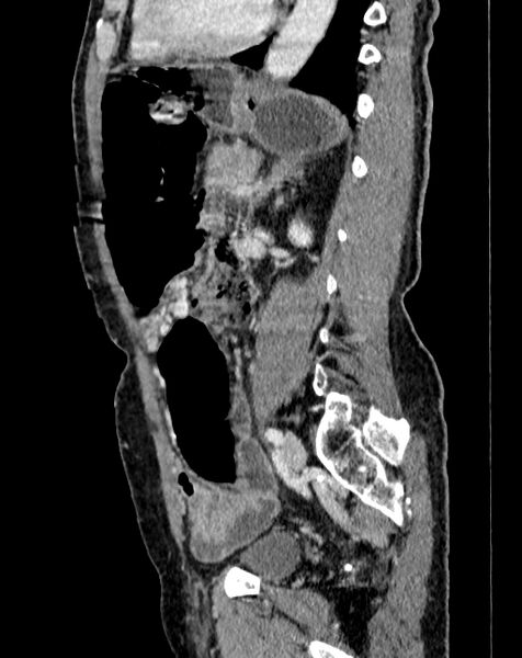 File:Abdominal aortic aneurysm (Radiopaedia 83581-98689 Sagittal C+ portal venous phase 78).jpg