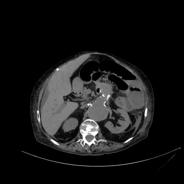 File:Abdominal aortic aneurysm - impending rupture (Radiopaedia 19233-19246 Axial non-contrast 46).jpg