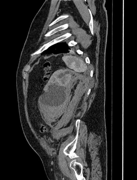 File:Abdominal aortic aneurysm rupture (Radiopaedia 54179-60362 Sagittal C+ arterial phase 39).jpg