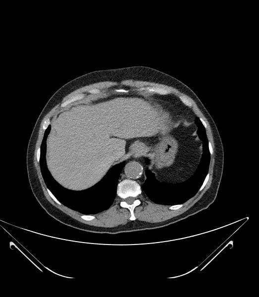 File:Abdominal aortic aneurysm with thrombus fissuration (Radiopaedia 46218-50618 Axial non-contrast 8).jpg