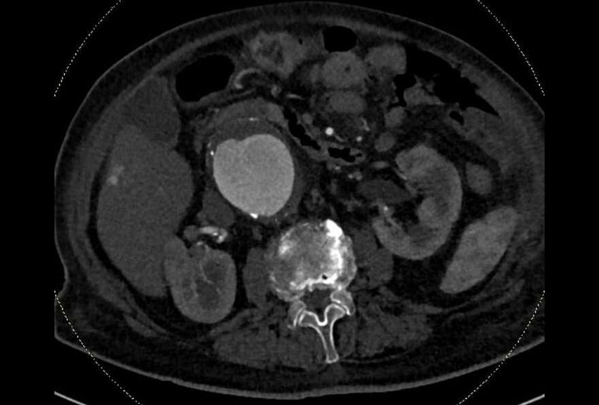 Abdominal aortic aneurysm with thrombus fissuration (Radiopaedia 73192-83919 Axial C+ arterial phase 70).jpg