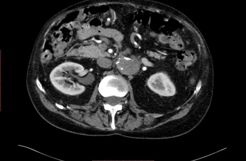 File:Abdominal aortic interposition tube graft and aneurysm thrombosis (Radiopaedia 71438-81857 Axial C+ arterial phase 51).jpg
