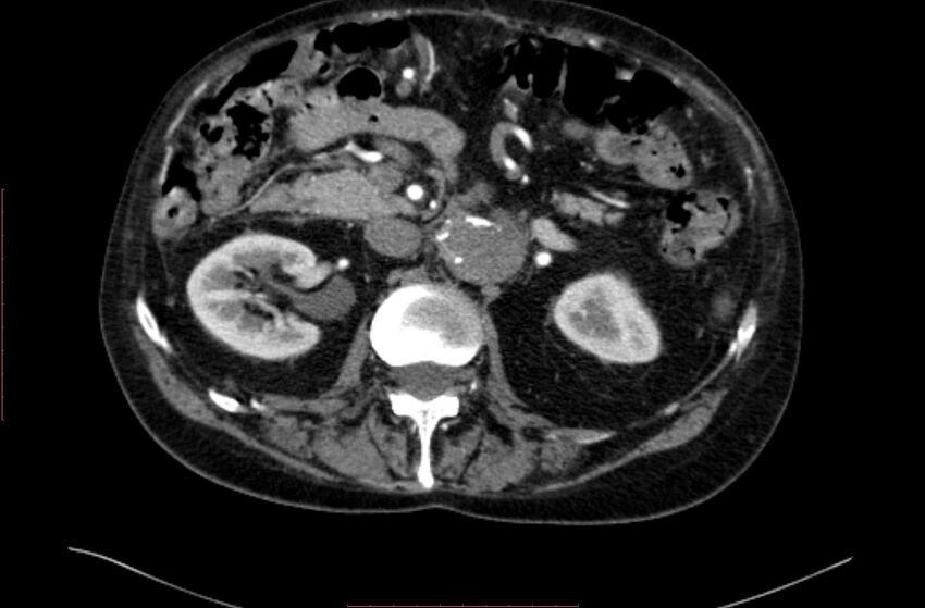 Abdominal aortic interposition tube graft and aneurysm thrombosis (Radiopaedia 71438-81857 Axial C+ arterial phase 51).jpg