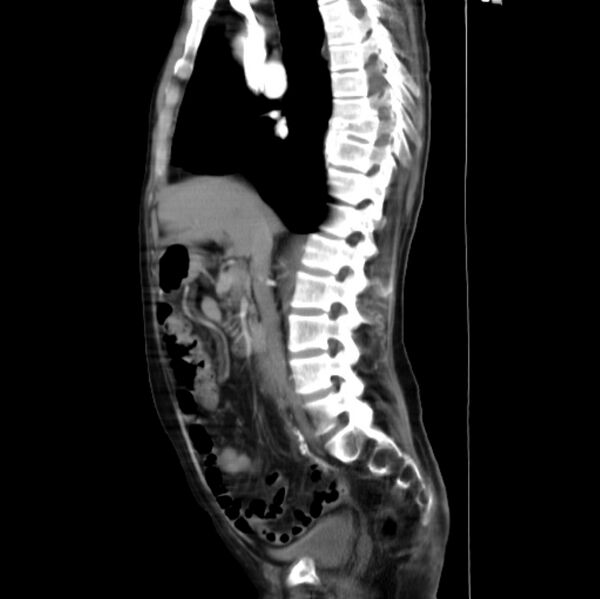 File:Abdominal aortic interposition tube graft and aneurysm thrombosis (Radiopaedia 71438-81857 Curved Sagittal C+ arterial phase 5).jpg