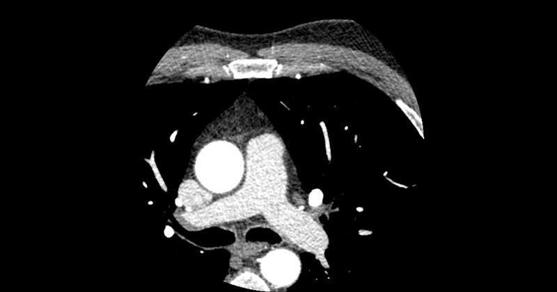 File:Aberrant left main coronary artery (ALMCA) arising from the right sinus with interarterial course (Radiopaedia 63251-71814 Axial C+ arterial phase 17).JPG