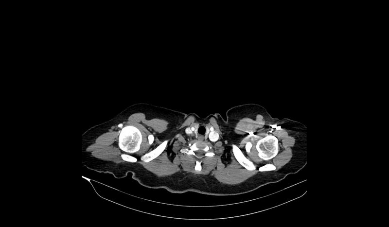 File:Acquired tracheo-esophageal fistula (Radiopaedia 51356-57103 Axial C+ arterial phase 3).jpg