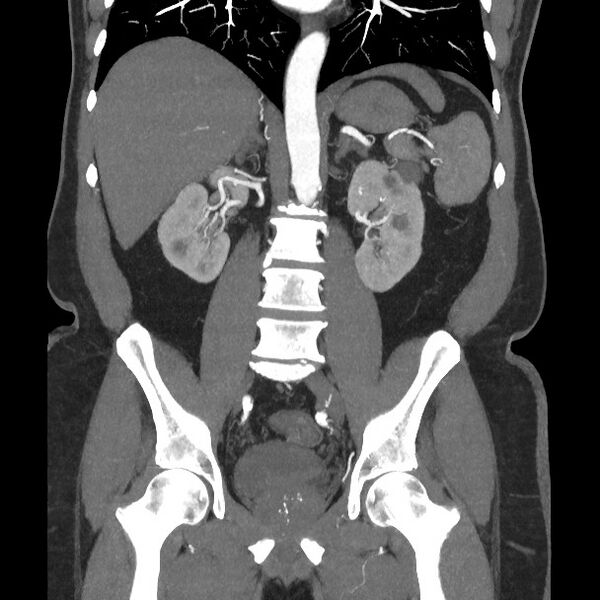 File:Active colonic bleed on CT (Radiopaedia 49765-55025 Coronal art MIP 38).jpg