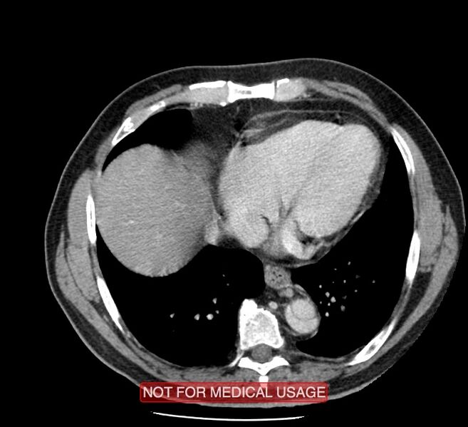 File:Acute aortic dissection - Stanford type A (Radiopaedia 40661-43285 Axial C+ portal venous phase 44).jpg
