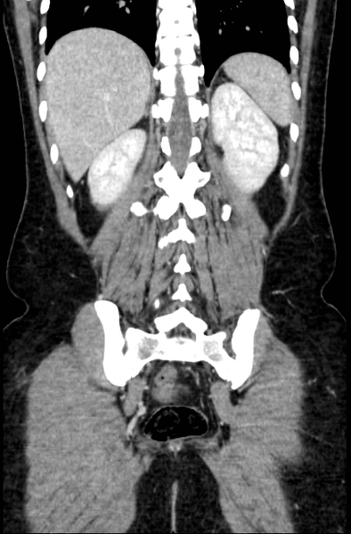 File:Acute appendicitis (Radiopaedia 22892-22918 Coronal C+ portal venous phase 45).png