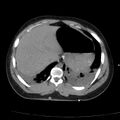 Acute aspiration pneumonitis (Radiopaedia 33605-34703 Axial non-contrast 72).jpg