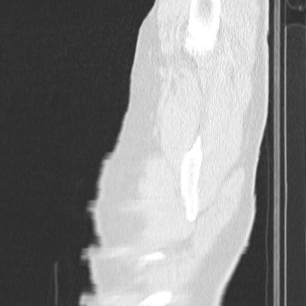File:Acute aspiration pneumonitis (Radiopaedia 33605-34703 Sagittal lung window 4).jpg