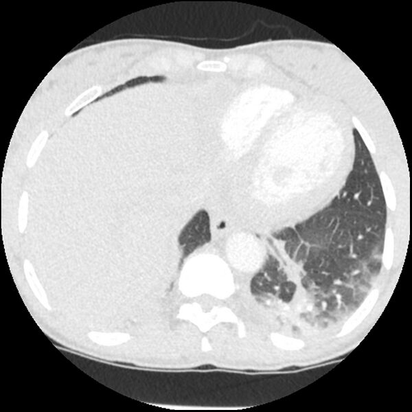 File:Acute chest syndrome - sickle cell disease (Radiopaedia 42375-45499 Axial lung window 155).jpg
