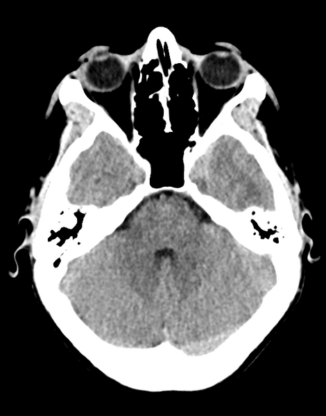 File:Acute disseminated encephalomyelitis (ADEM) (Radiopaedia 65319-74348 Axial non-contrast 10).png