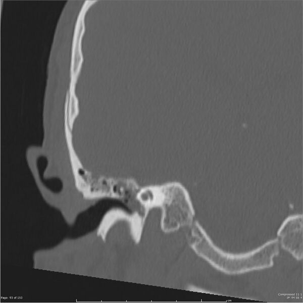 File:Acute otomastoiditis (Radiopaedia 28276-28512 Coronal PTB bone window reformat 24).jpg