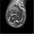 Acute pancreatitis (Radiopaedia 19135-19116 Coronal non-contrast 3).jpg